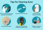 Best Methods For Teenagers For Treating Acne