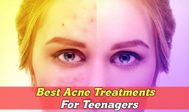 Best acne treatments for teenagers